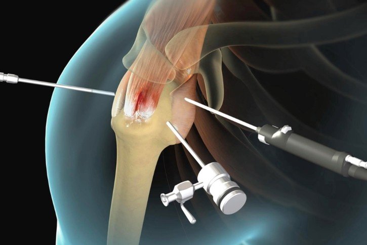 Rotator Cuff Tear Treatment in Gurugram