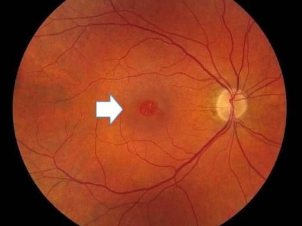 Best Macular Hole Treatment in Gurugram
