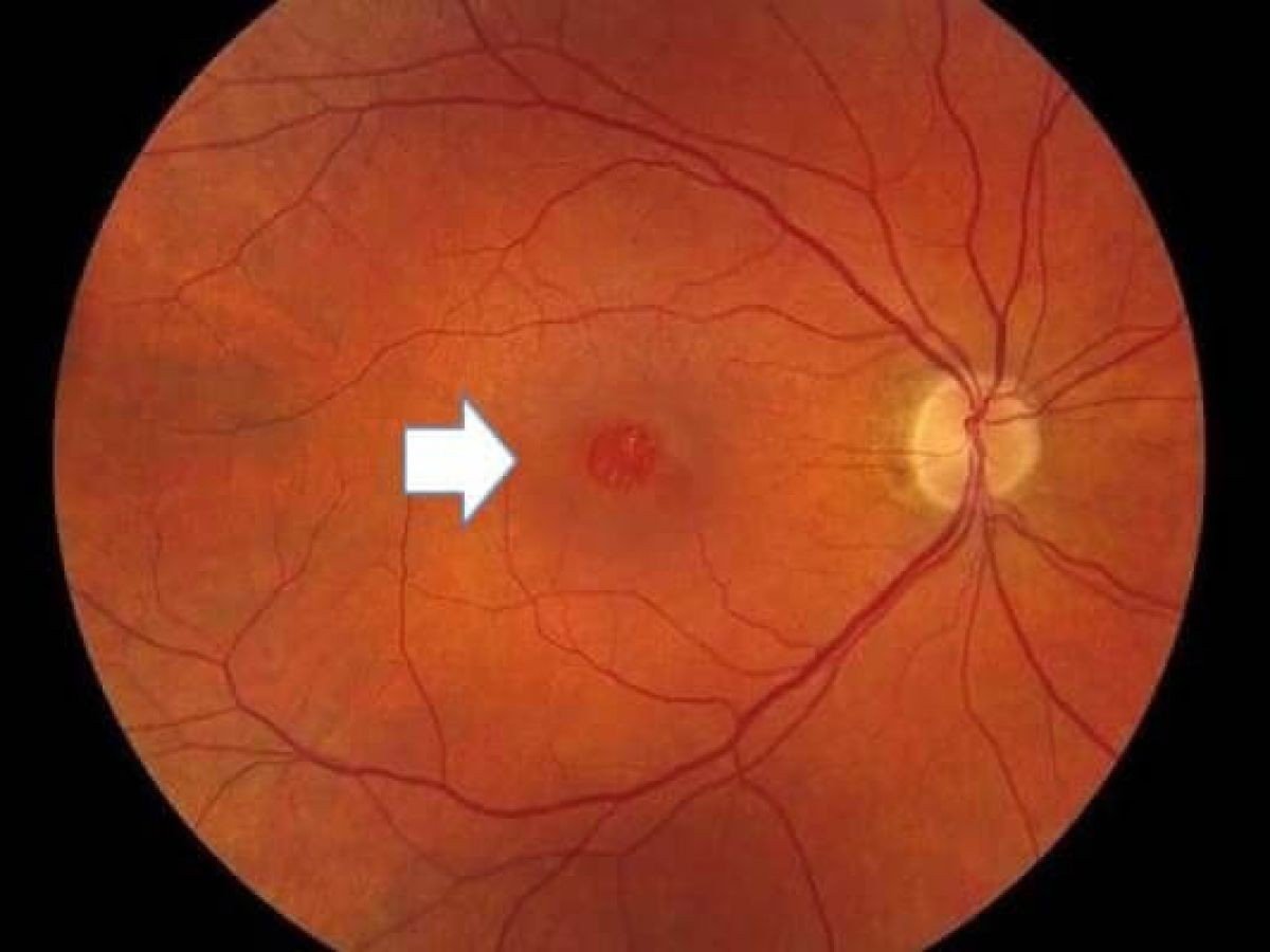 Best Macular Hole Treatment in Gurugram