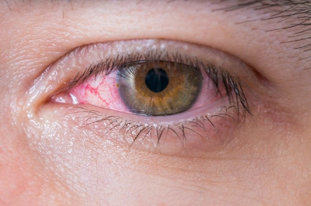 Eye Irritation Treatment in Gurgaon